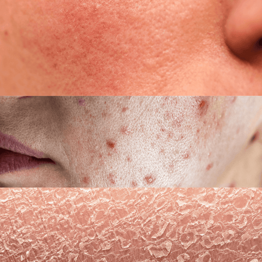 Damage to the Skin Barrier: Understanding, Causes, and Solutions - NaturaXotic