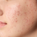 Adult Acne