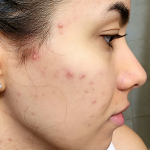 Hormonal Acne