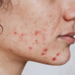 Cystic Acne